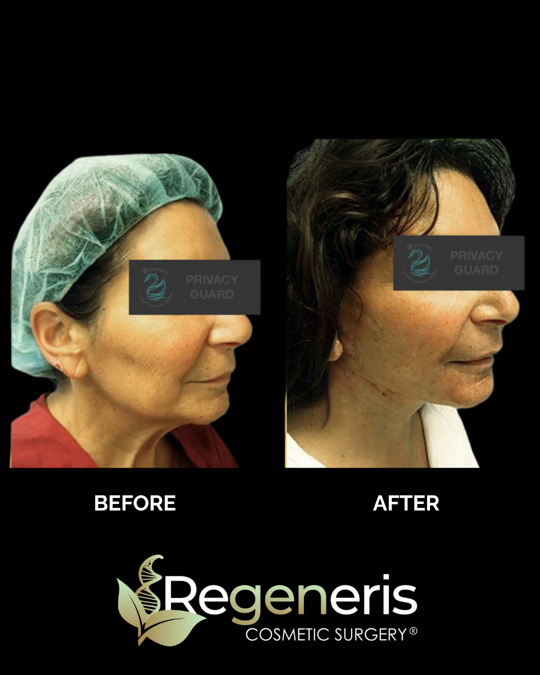 Before and after facelift: patient profile showing enhanced cheekbones and firmer facial structure