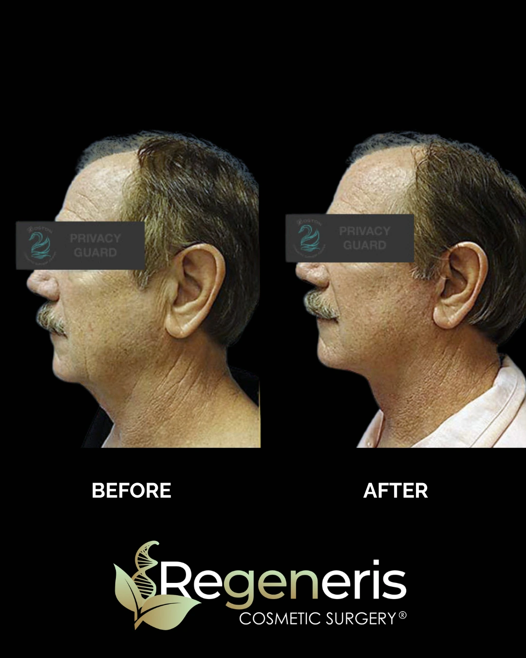 Before and after facelift: patient profile showing lifted jawline and improved facial definition