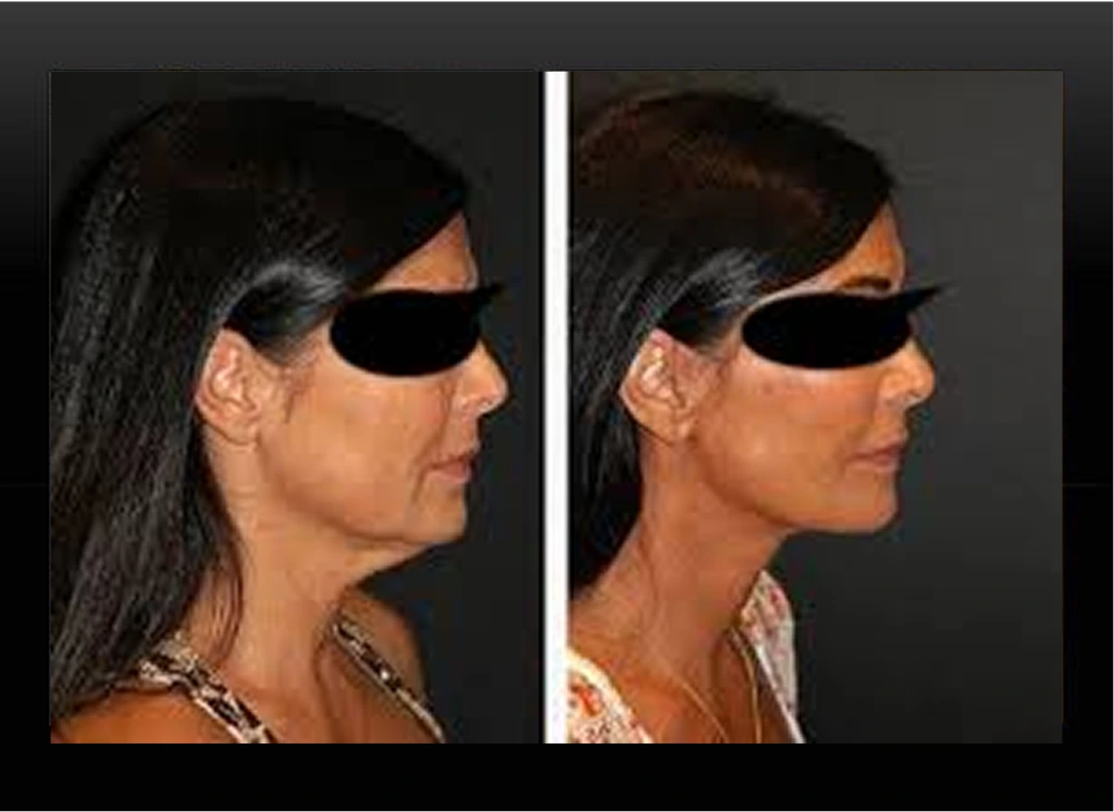 Before and after side profile comparison of a woman's face and chin definition