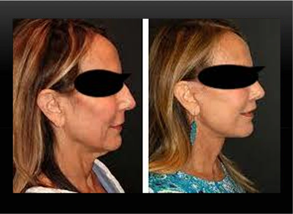 Before and after side profile comparison of a woman's face and jawline