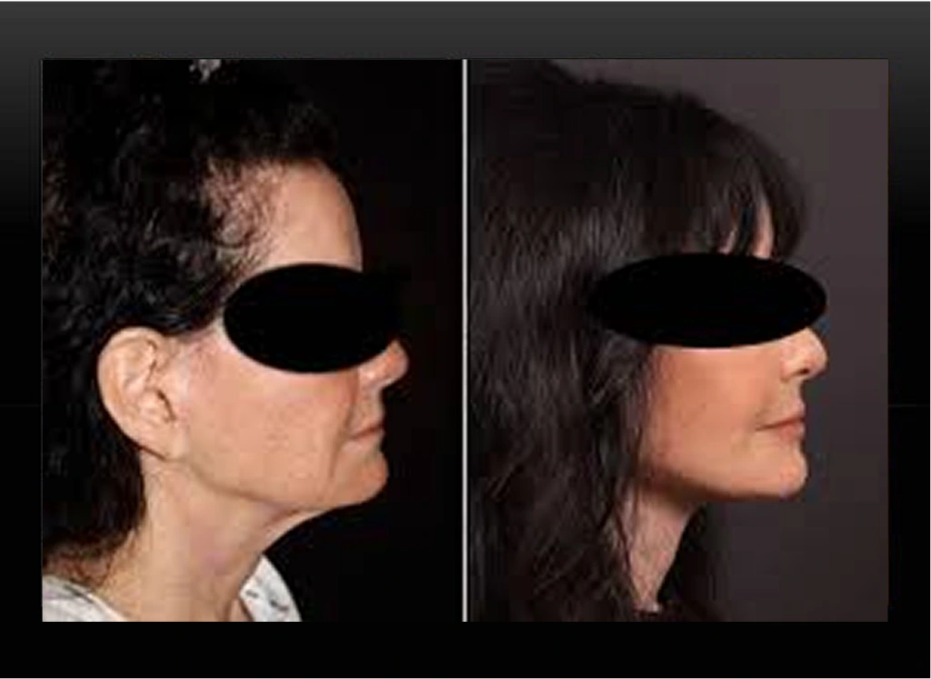 Before and after side profile comparison of a woman's face and neck