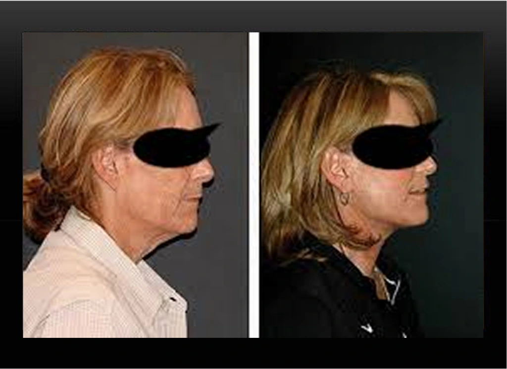 Before and after facelift comparison showing side profile views of a woman's face with eyes obscured