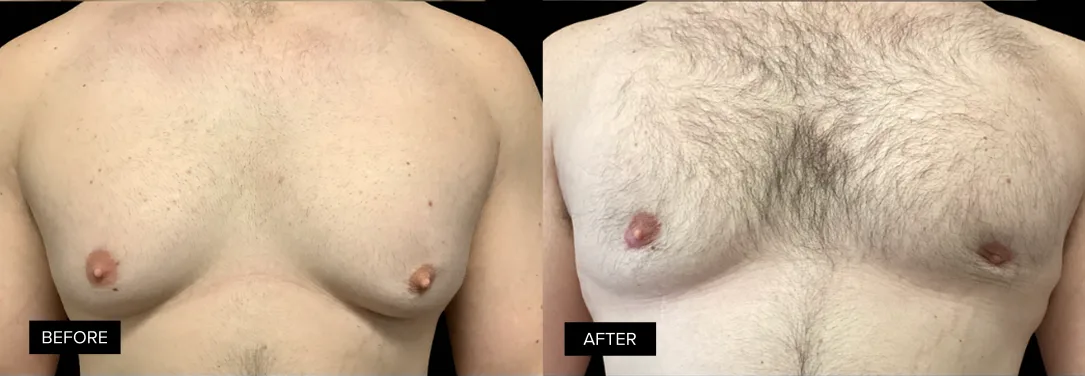 Male chest before and after gynecomastia treatment, frontal view showing diminished breast tissue and contour improvement