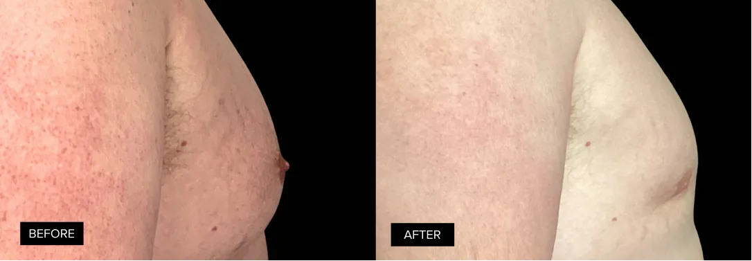 Male chest before and after gynecomastia treatment, side profile with visible flattening of chest area