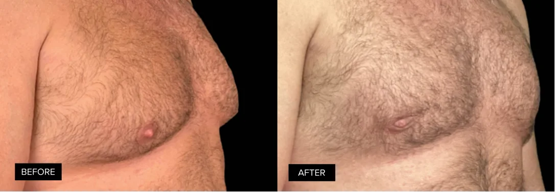 Male chest before and after gynecomastia treatment, side view showing reduced fullness and improved definition