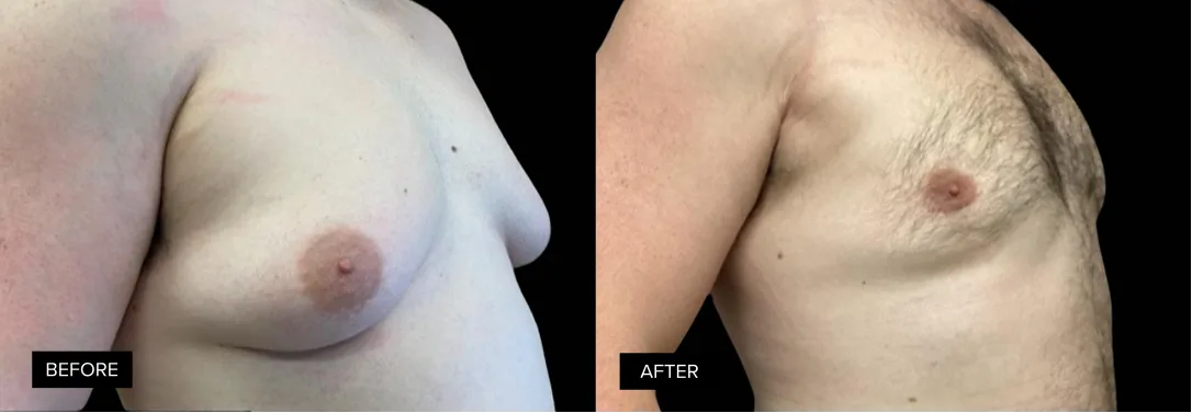 Male chest before and after gynecomastia treatment, side profile demonstrating decreased breast projection