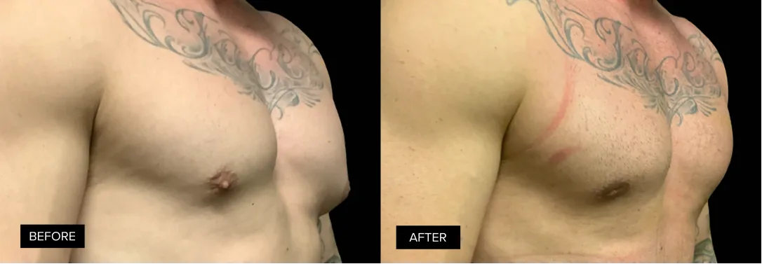 Male torso before and after gynecomastia treatment, angled side view showing firmer chest contour