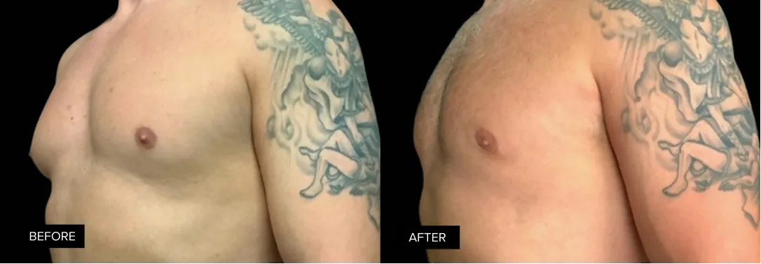 Male chest before and after gynecomastia treatment, frontal view with visible reduction in breast tissue