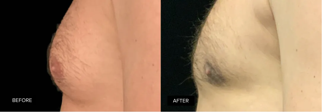 Before and after male gynecomastia treatment showing flattened chest contour