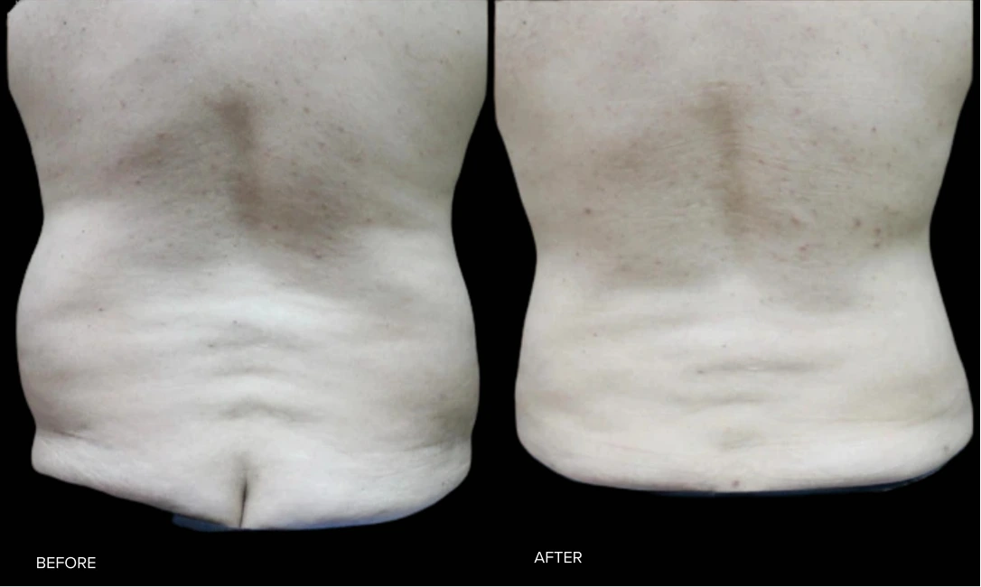 Before and after comparison of abdominal liposuction results