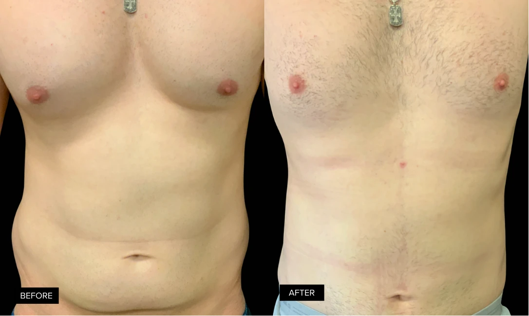 Before and after comparison of male chest liposuction results