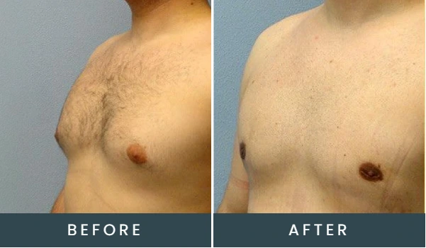 Before and after side-view comparison of male chest with body hair, showing flatter contour