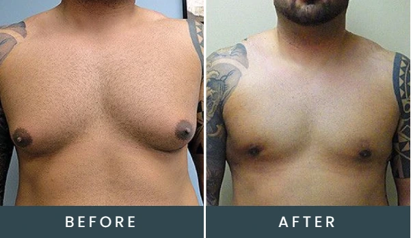 Before and after comparison of male chest, showing reduced gynecomastia