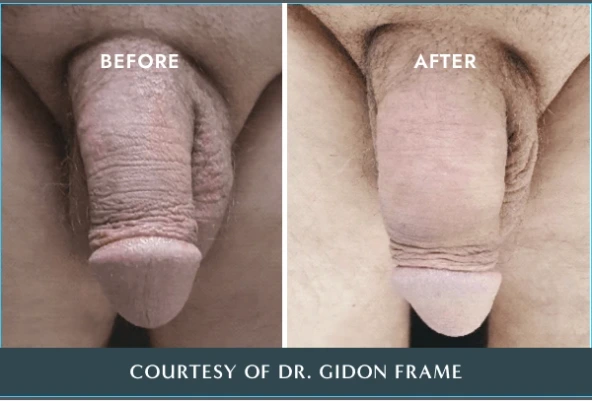 Before and after comparison of penile treatment by Dr. Gidon Frame showing reduced wrinkles and improved skin smoothness