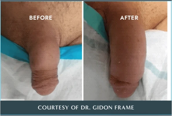 Before and after comparison of penile treatment by Dr. Gidon Frame showing reduced wrinkles and improved skin texture