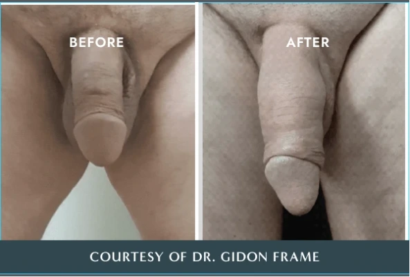 Before and after comparison of penile treatment by Dr. Gidon Frame showing improved tissue appearance and texture