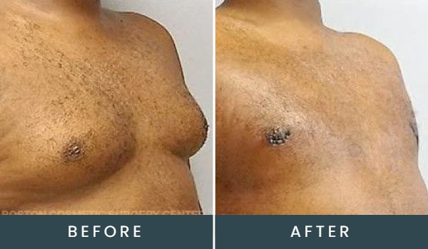 Before and after comparison of male chest, showing reduction in breast prominence