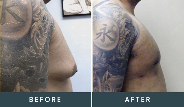 Before and after comparison of male torso with large tattoo, showing improved chest contour