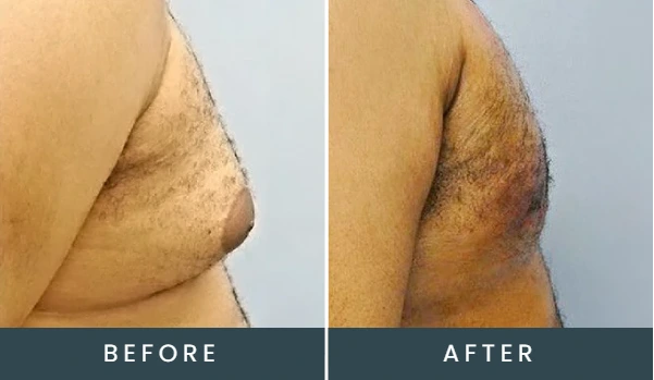 Before and after side-view comparison of male chest, showing improved definition
