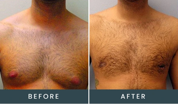 Before and after chest showing reduced hair density and skin tone change