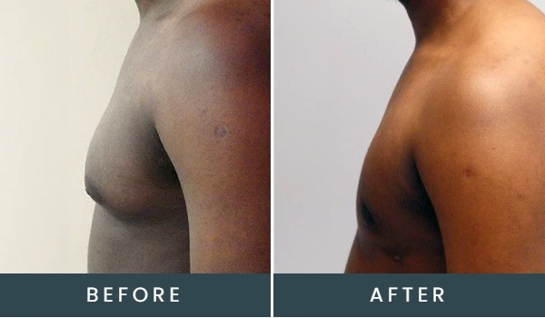 Before and after side view of torso showing reduced gynecomastia