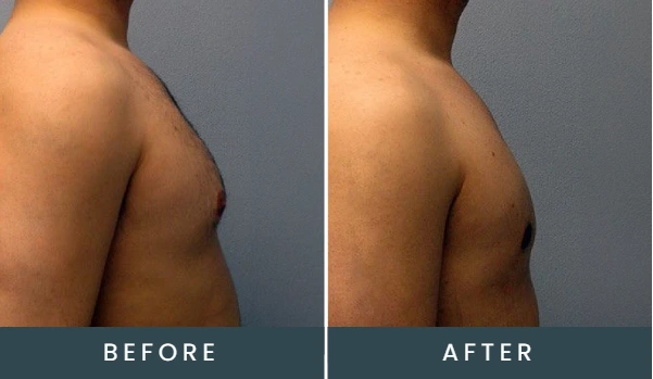 Before and after side view of back and shoulder showing body contouring