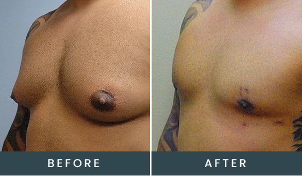 Before and after side-view comparison of male chest, showing reduced breast tissue