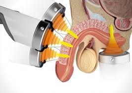 Medical device with white applicator head and orange/yellow components demonstrating tissue penetration treatment