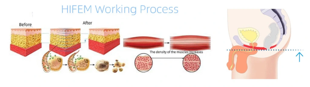 HIFEM Working Process diagram showing tissue layers before and after treatment with muscle density comparison and injection site
