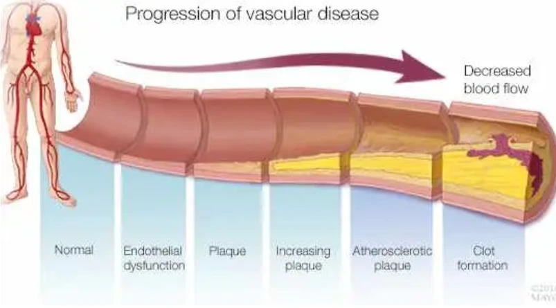 Anatomical diagram illustrating progression of vascular disease from normal vessel to clot formation, showing stages of endothelial dysfunction, plaque buildup, and decreased blood flow