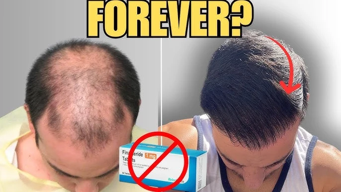 Before-and-after comparison with text FOREVER?: man with hair loss on left, fuller hair on right, with finasteride box crossed out