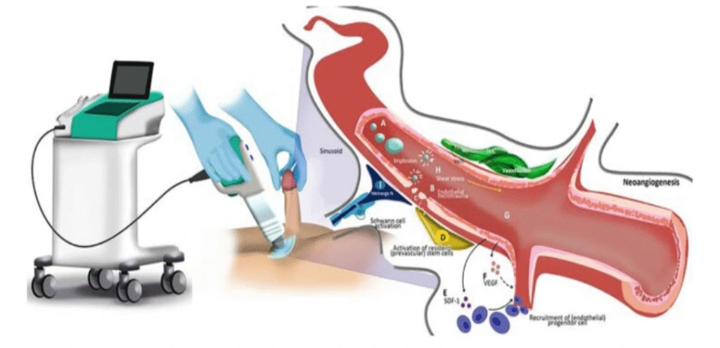 Shockwave therapy device on left with applicator handpiece applied to patient's skin, anatomical diagram showing energy waves penetrating tissue layers on right