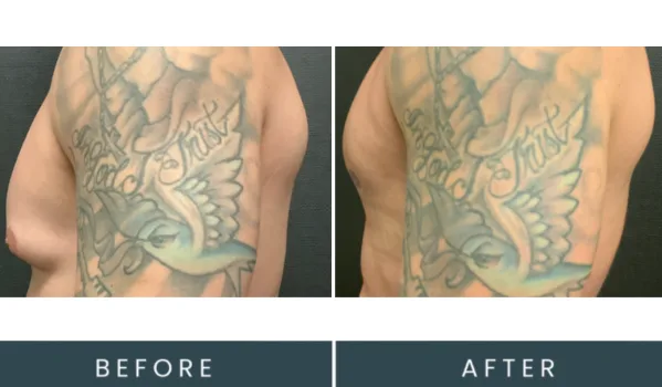 Before and after comparison of man's shoulder showing tattoo treatment results