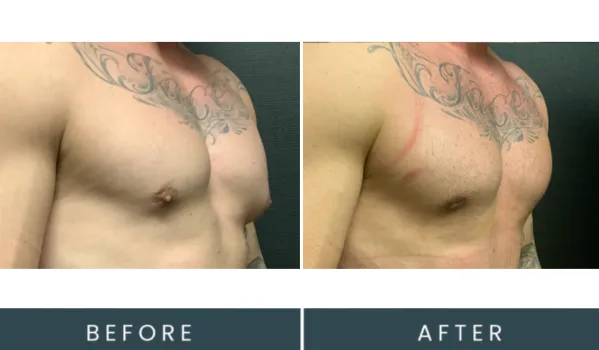 Before and after comparison of man's chest showing aesthetic treatment results