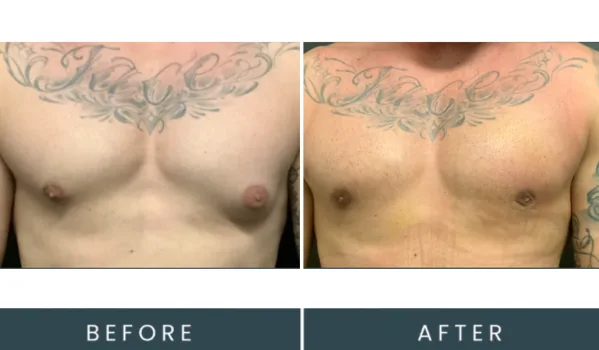 Before and after comparison of male chest with winged chest tattoo, showing skin texture and tone changes