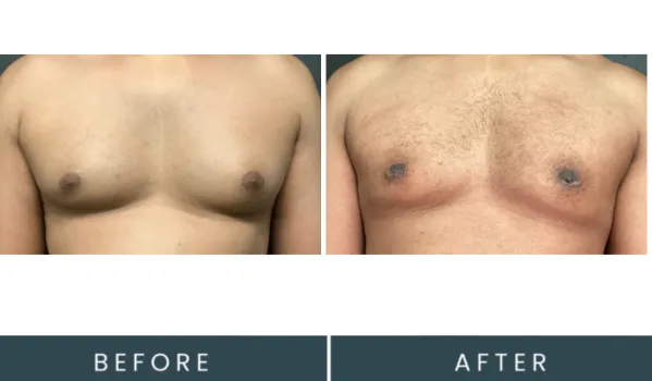 Before and after comparison of male chest showing skin appearance and texture changes