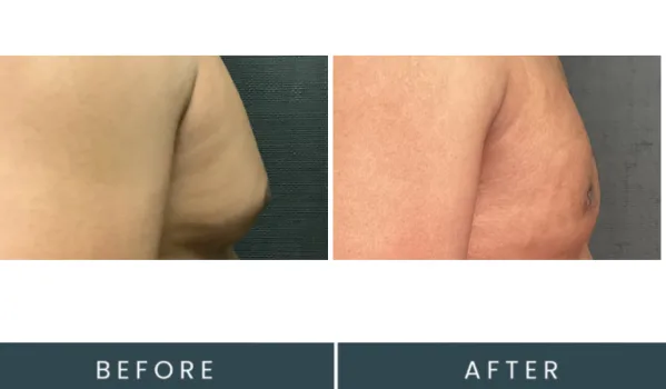Before and after side-by-side comparison showing body contouring results, labeled Before and After