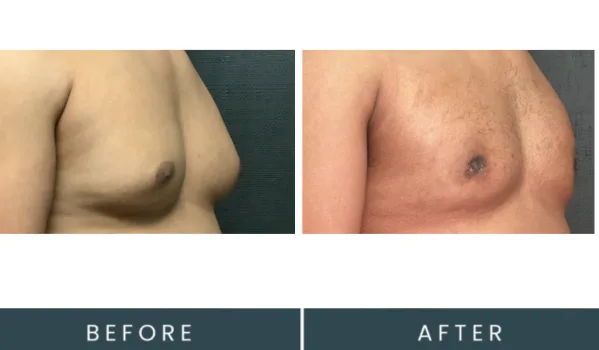 Before and after side profile comparison of male chest showing skin tone and texture changes
