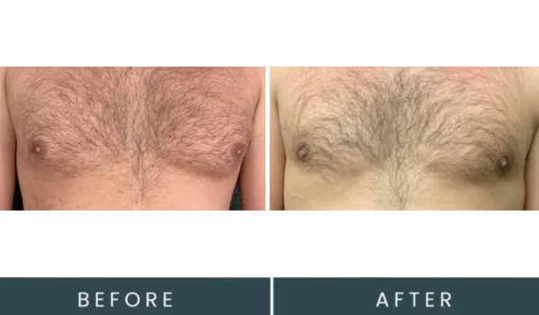 Before and after frontal comparison of male chest with body hair, showing skin appearance changes