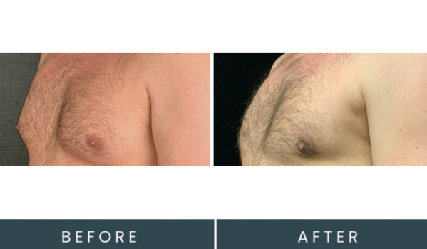 Before and after side profile comparison of male chest with body hair, showing skin texture changes