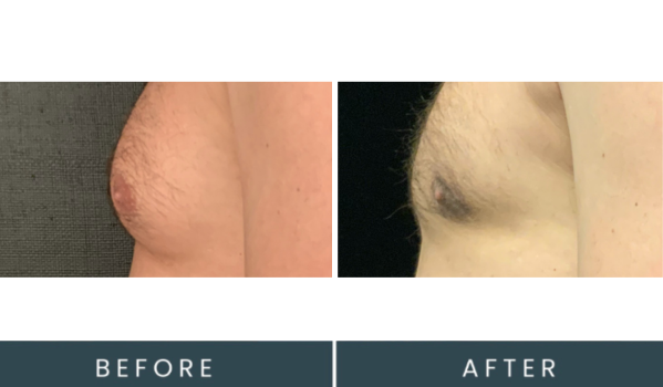 Before and after side profile comparison of male chest showing skin tone and appearance changes