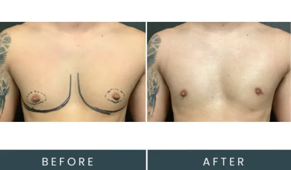 Before and after chest comparison showing surgical marking and post-procedure result