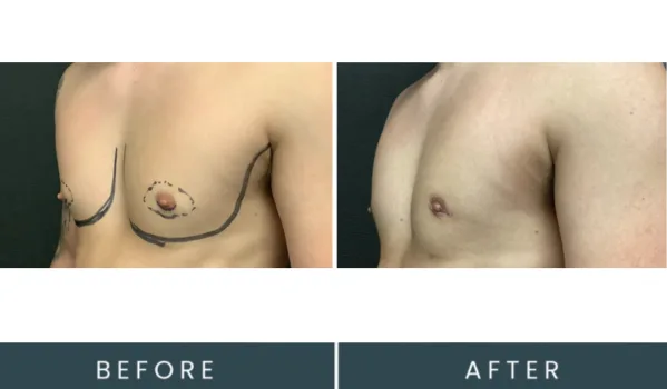 Before and after side profile chest comparison showing surgical marking and post-procedure result
