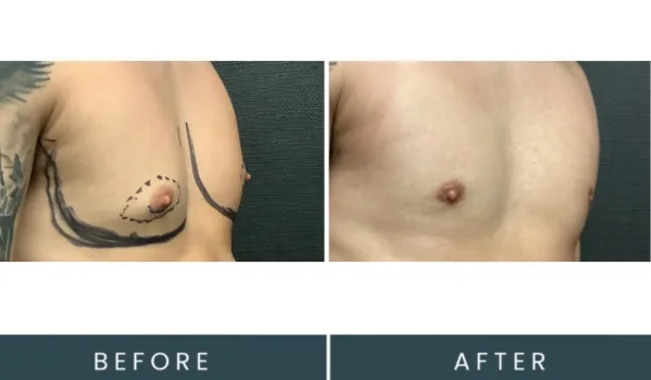 Before and after angled chest comparison showing surgical marking and post-procedure result