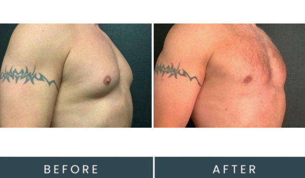 Before and after chest comparison showing initial presentation and post-procedure result with skin tone change