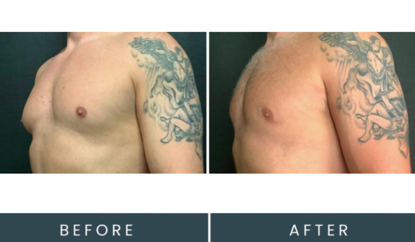 Before and after side profile chest comparison showing initial presentation and post-procedure result