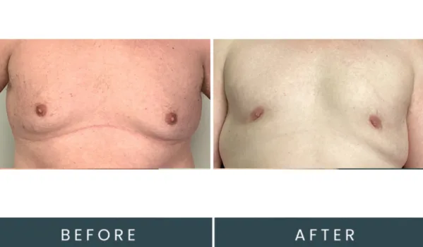 Before and after frontal view showing chest contour treatment results