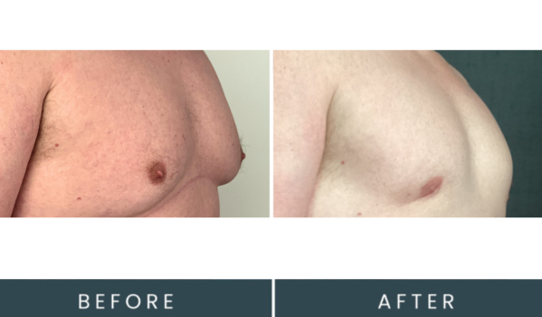 Before and after oblique view showing chest contour treatment results