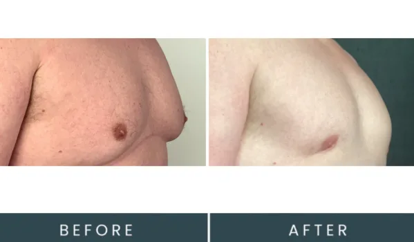 Before and after oblique view showing chest contour treatment results