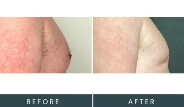 Before and after side view showing chest contour treatment results
